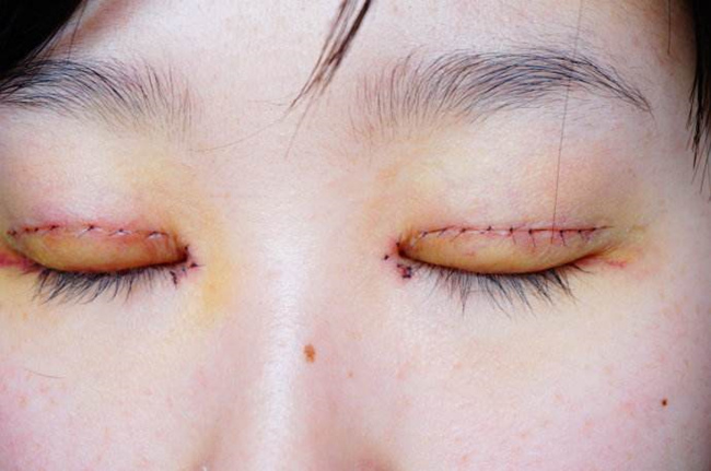 割双眼皮的坏处 坏处要怎样化护理？美容师告诉你