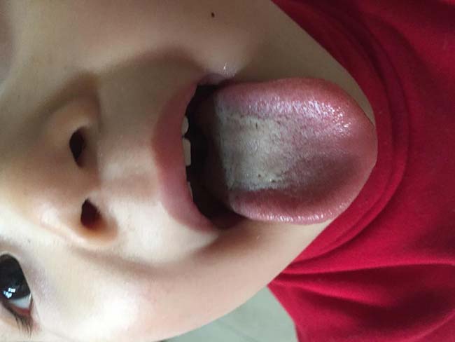 舌苔厚黄是怎么回事 舌苔上的变化说明身体的亏损