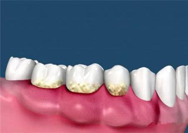 牙结石形成原因 揭秘牙结石的危害!改变几个刷牙小习惯