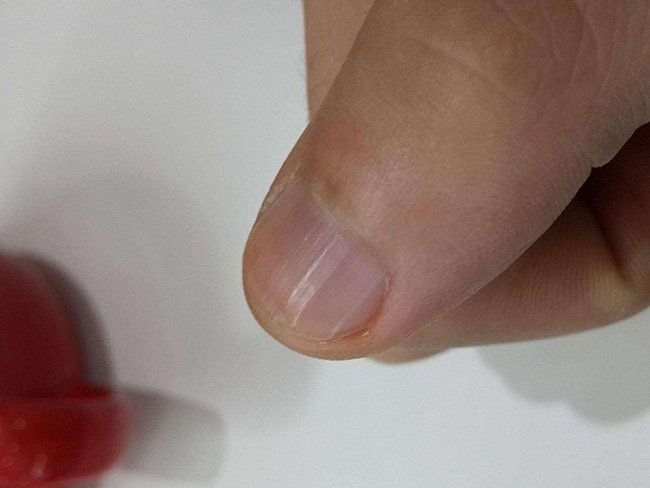 手指甲上有竖纹 指甲出现5种情况都是大病来临的前兆