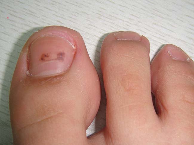 脚指甲有黑点是怎么回事 指甲无故有黑点原来都是因为它