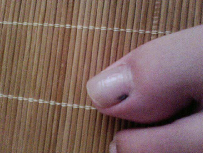 脚指甲有黑点是怎么回事 指甲无故有黑点原来都是因为它