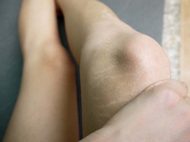 膝盖上出现白色条纹 这种成长的印记很多人想要都没有