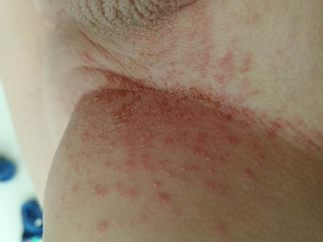 乙肝小红点图片 详细分析乙肝的病理症状以及原因