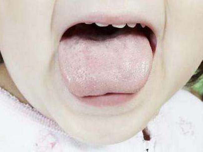 舌苔黄腻是什么原因 看似一样但因这几个细节相差甚远