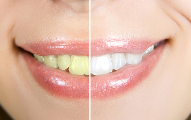 牙齿很黄怎么都刷不白 牙膏加上它不出一个月齿如白瓷