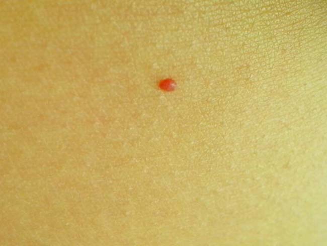 皮肤上出现红色血点 身体各处莫名出现红色小点不痛不痒