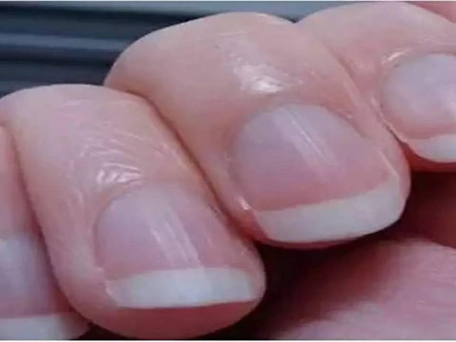 手指甲上有竖纹的原因 出现这种竖纹就是大病将至的预兆