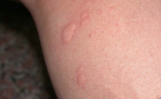 荨麻疹反反复复发作瘙痒难忍 引起荨麻疹的病因都有哪些