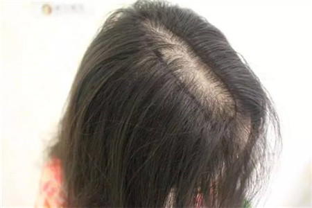 产后脱发是哪些原因造成的，需要治疗吗