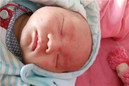 宝宝湿疹是怎么引起的，推荐三个护理方法